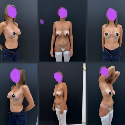 абдоминопластика и маммопластика