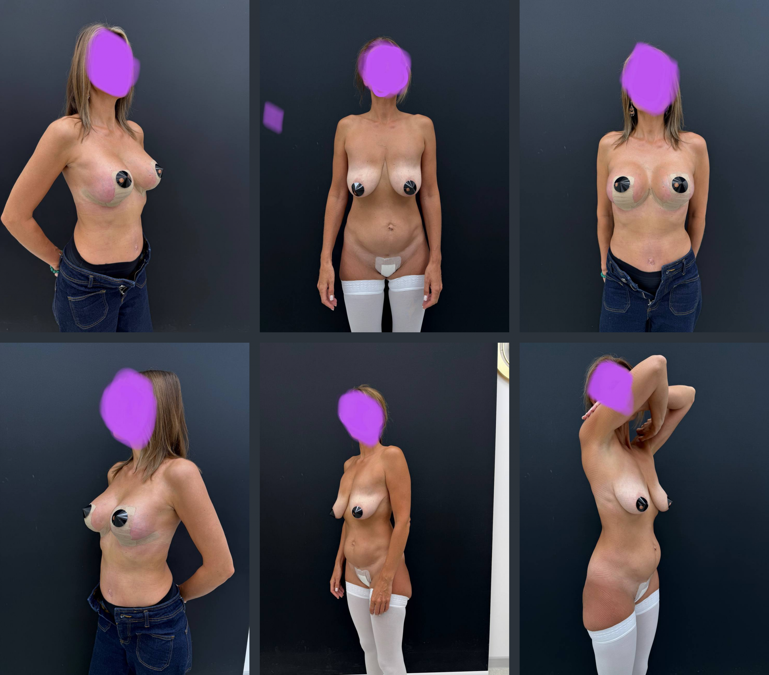 абдоминопластика и маммопластика